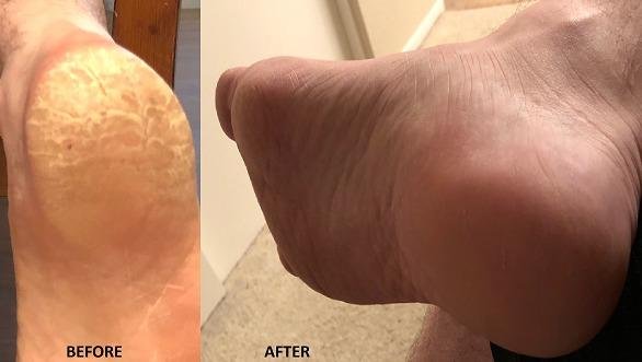 Colossal Foot rasp Foot File and Callus Remover. Best Foot Care Pedicure Metal Surface Tool to Remove Hard Skin. Can be Used on Both Wet and Dry feet, High Grade Stainless Steel File customer photo 2