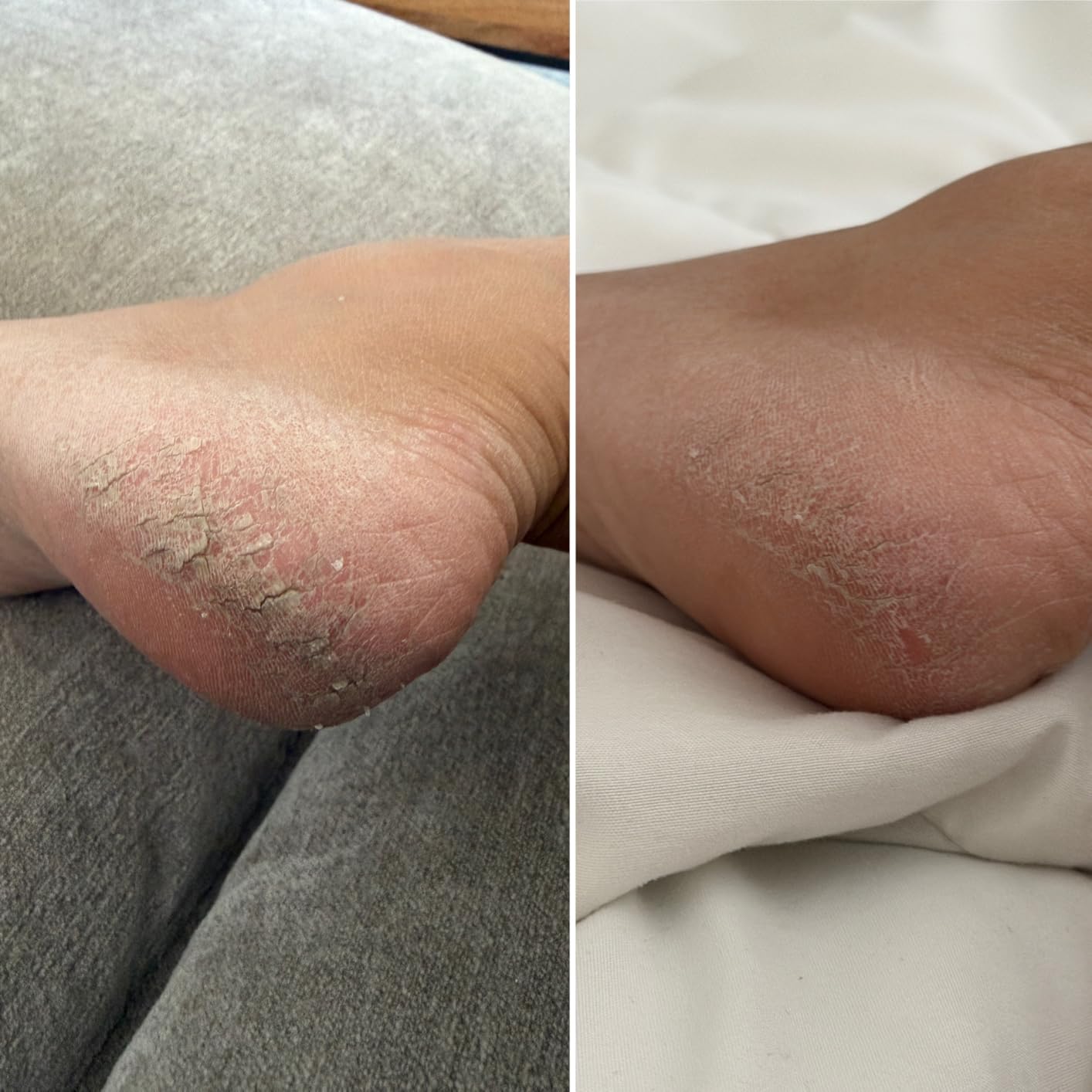 Ebanel Urea Cream 40% plus Salicylic Acid 2% for Dry Cracked Feet Skin customer photo 1