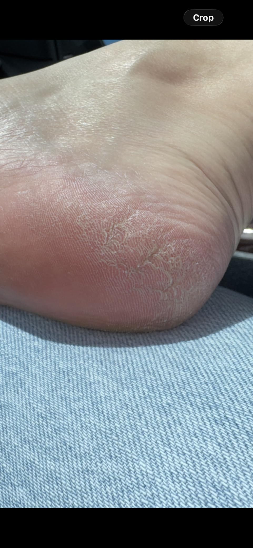 Ebanel Urea Cream 40% plus Salicylic Acid 2% for Dry Cracked Feet Skin customer photo 2